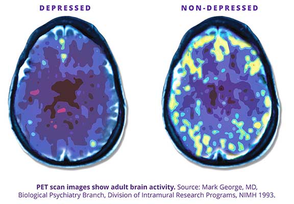 Brain Scan Image before TMS Depression Treatment and after TMS Depression Treatment.